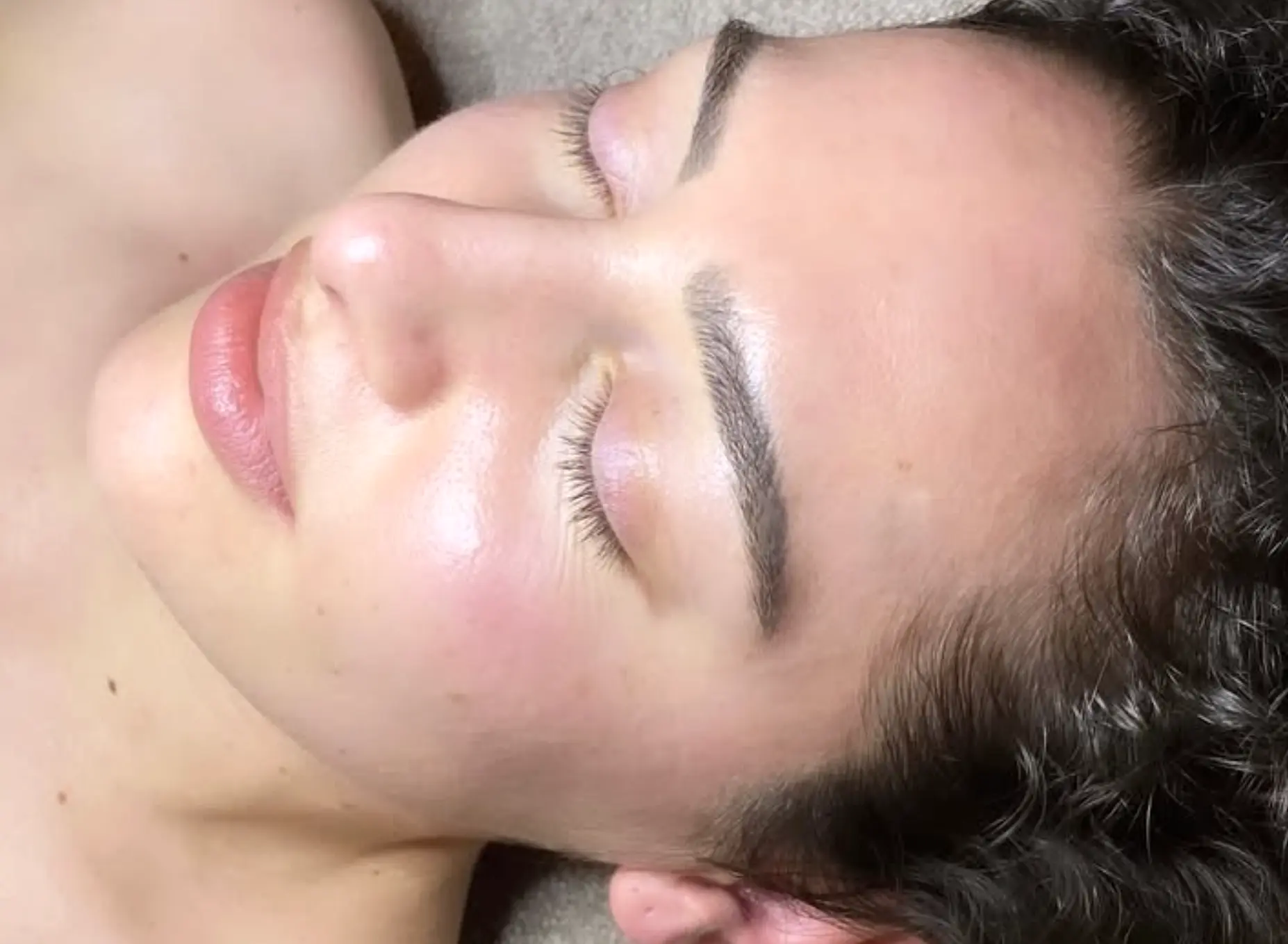 Microneedling with Brightening Serums